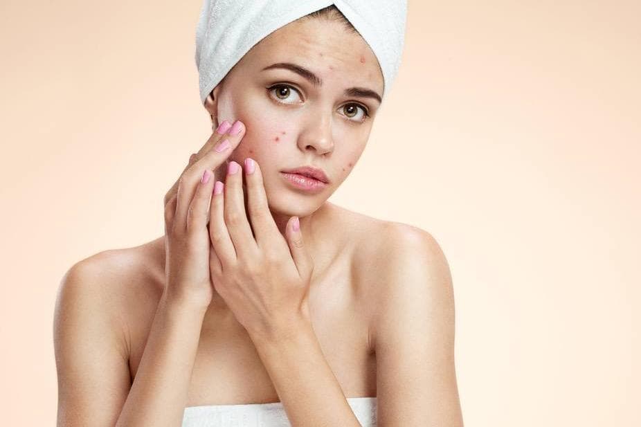 5 Sai lầm thường mắc phải khiến tình trạng mụn của bạn càng nặng hơn